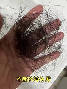 VETES | Anti-hair Loss Shampoo For Dandruff Control Oil Balance and Volumizing
