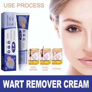 Ubat Buang Kutil Ketuat Tahi Lalat Biji Kolestrol Painless Wart Treatment Cream Wart Removal Ointment Skin Tag Remover