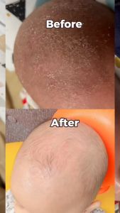 FORA Minyak Kerak Kepala Cradle Cap Bayi