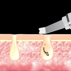 เครื่องสครับผิวหน้าเทคโนโลยีไอออน 6-in-1 ทำความสะอาดลึก กําจัดสิวหัวดำ-สิวเสี้ยน พร้อมผลักครีมบำรุงผิวและยกกระชับ เหมาะกับทุกสภาพผิว Ultrasonic Skin Scrubber