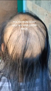 Best Seller POLYGONUM MULTIFLORUM SHAMPOO BAR SOAP | Promoting Hair Growth Strengthening Hair Roots & Potentially Darkening Gray Hair | Oil Control & Moisturizing | Prevents Hair Loss | Organic Natural Shampoo Bar for Treated Dry Damaged Hair