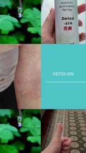 Detox-Xin Herbal Antiseptic Spray for Eczema Acne Skin Infections Psoriasis
