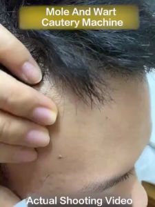 [Holly] Portable Laser Plasma Pen Facial Freckle Dark Warts Spot Mole Removal Machine