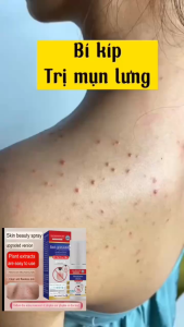 Xịt Mụn Lưng Dưỡng Da Toàn Thân Trị Mụn Mờ Thâm Khô Cồi Mụn Nhanh Chóng Dùng Cho Nam Nữ