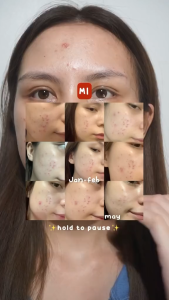 OMG Mugwort Acne Serum Salicylic Acid 20ml Perawatan Kulit Berjerawat Murah