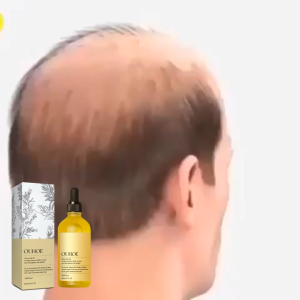 OUHOE Rosemary Dense Hair Essential Oil Anti Hair Loss Treatment Promote Hair Growth Strengthen Hair Scalp Nourishing Oil With Rosemary Castor Argan Coconut Oil Reduce Hair Fall Receding Hairline 60ml