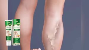 Leg Edema Relief Ointment Remove Leg Swelling Repair Varicose Veins Antiedematous Foot Improves Circulation Anti Edema Ointment