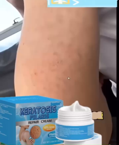 Kem Dưỡng Da Keratosis Pilaris Repair Cream 10% Urea Và Vitamin E Giúp Làm Mịn Da Sần Sùi Hiệu Quả Dành Cho Các Chị