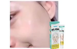 Penghilang Flek Hitam Membandel di Wajah: Salep Cream Pemutih & Krim Penghilang Flek