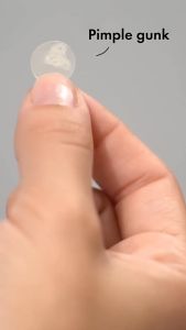 Stiker Jerawat YUONE: Solusi Efektif untuk Menghilangkan & Mencegah Jerawat