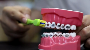 Qolu Dental Toothbrush V Shape Orthodontic Oral Cleaning Care Recommended By Dentist Soft Bristle Compact 5680