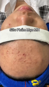 Serum giảm mụn Lá Mộc MH Luxury – Tinh chất làm khô cồi mụn dịu da phục hồi da hư tổn giảm đỏ thu nhỏ lcl 10ml