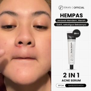 TERATU BEAUTY 2 in 1 Acne Serum - 20 ml (untuk Jerawat Mendem dan Mencegah Noda Bekas Jerawat)
