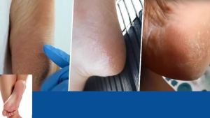 Kem Urea Dâu Tây Dành Cho Tay Và Chân Dưỡng Ẩm Sâu Tẩy Tế Bào Chết Làm Dịu Da Chăm Sóc Da Ngăn Ngừa Khô Và Nứt Nẻ Dụng Cụ Chăm Sóc Tay Không Dùng Điện