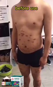 ubat gatal kulit Eczema cream Removal eczema psoriasis ringworm Ubat gatal kulit Antifungal cream psoriasis Krim gatal celah kangkang krim gatal ubat gatal kemaluan Antibacterial cream  Natural Ingredients Itching cream 牛皮癣 止痒膏 百草抑菌膏 30g