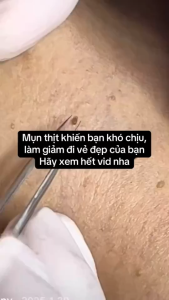 Kem rụng Hỗ trợ chăm sóc các nốt mụn thịt dư nốt sần nhỏ trên da.