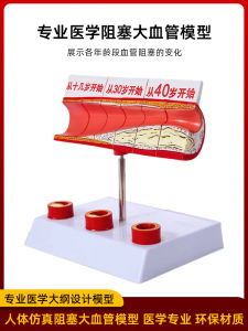 Cardiovascular and Cerebrovascular Blockage Model Joint Thrombosis Blood Concentration Fat Pathology Atherosclerosis Human Anatomy Teaching Aids