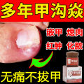 Paronychia Anti-Inflammatory Detumescence Treatment Special Purpose Chemicals Finger Toenail Onyxis Corrector Removing Polyp Bud Purulent Ointment. 