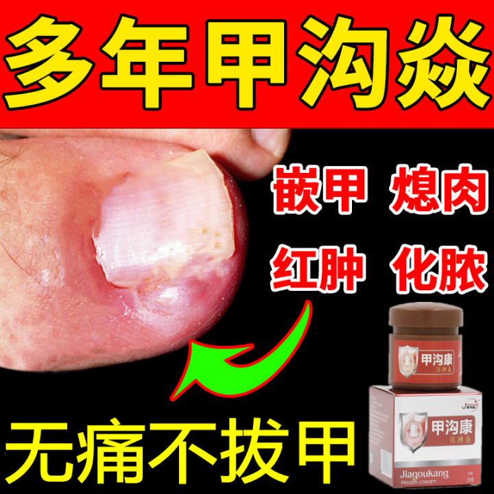 Paronychia Anti-Inflammatory Detumescence Treatment Special Purpose Chemicals Finger Toenail Onyxis Corrector Removing Polyp Bud Purulent Ointment