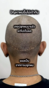 Hanafy Nuva SMP folicule Scalp Pigment 20ml. สีฝังไรผม สีฝังตอผม เชื้อน้ำ สีรัสเซีย คุณภาพสูง พร้อมส่ง เลือกสีในตัวเลือก