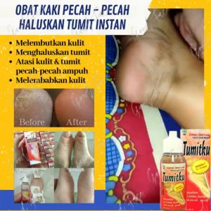 Tumitku 30 ml: Solusi Penghilang Kapalan & Kutu Air