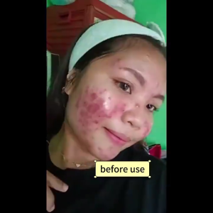 Salep Jerawat Acne Night Cream 50gr BPOM Krim Penghilang Bekas Jerawat Obat Jerawat paling ampuh Acne Day Cream Whitening Salep Bopeng Flek Noda Hitam Anti Acne Mengecilkan Poripori Mencerahkan kulit Memperbaiki Skin Barrier Acne Spot Treatment Expert