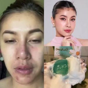 เซ็ตคู่เด็ด Daesung Soap & Picco Ampoule Serum แดซ็องพิคโคแอมพูล  ลดการเกิดสิว กระชับรูขมขน