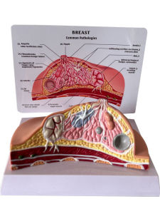 Pathological Breast Model Teaching Aids for Breast Anatomy Lymph Node Cancer Human Body Teaching Touch Model PVC Environmental Protection Grade