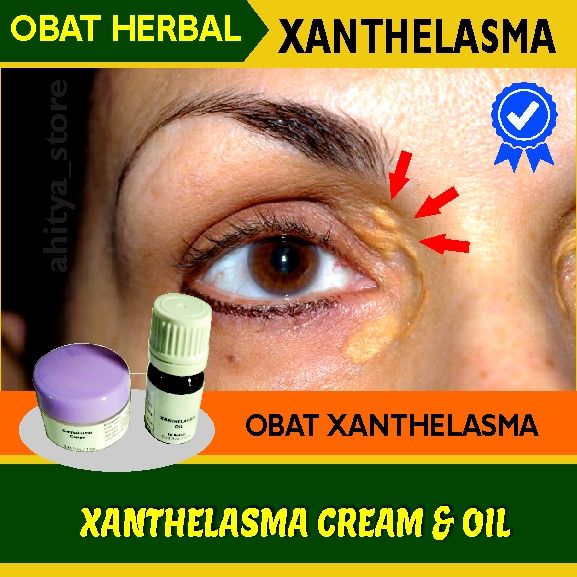 Obat Xanthelasma Mata Ori Xantelasma Cream 10gr Salep Penghilang