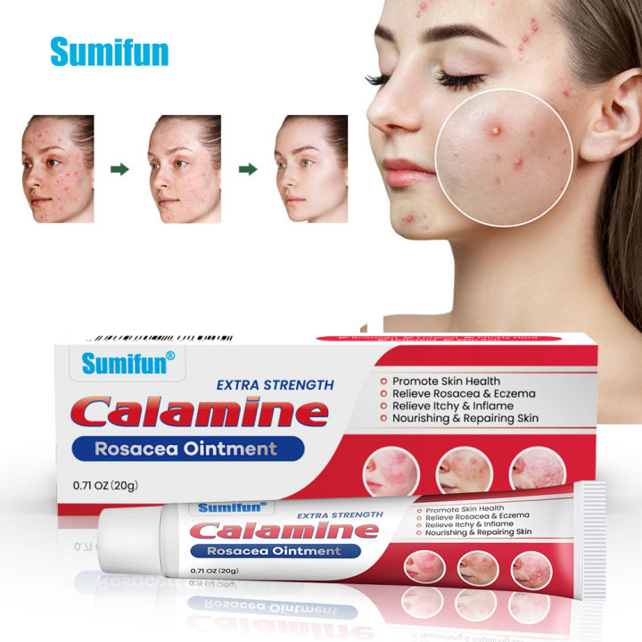 Calamine Acne Area Comfort Cream Gentle Calamine Acne Soothing Cream ...