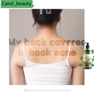 Anti Mite Body Wash 500ml Back Acne & Itchy Skin Relief Antifungal Eczema Psoriasis Treatment Amino Acid Shower Gel For Oily Sensitive Skin