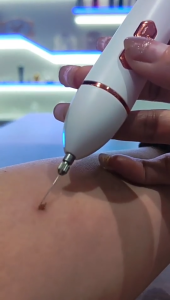 ปากกากำจัดไฝแบบพกพา ปากกากำจัดไฝในครัวเรือน เครื่องมือกำจัดไฝ เครื่องมือกำจัดไฝ