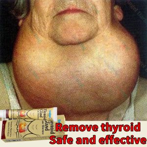 Goiter Hyperthyroidism 20g 甲状腺膏 Thyroid Gland Care  Hypothyroidism Thyroid Cyst Neck Bump Herbal Medicine No Surgery Needed Natural Healthy Powerful Chinese herbal medicine