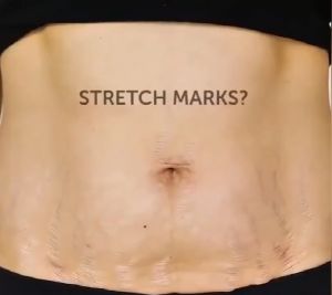 Aichun Pregnancy Body Cream Remove Body Stretch Marks Skin Care skin Care Stretch marks fat streaks Growth lines Moisturizing Body Cream Shrink Pores Facial Lifting Firming 60g 妊娠纹修复霜