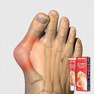 Cross Border Bunion & Rheumatism Cream: A Comprehensive Guide