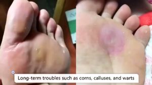 10pcs Feet Corns/ Warts Removal Patch Pain Relief Remover Feet Callus Remove Soften Skin Cutin Sticker Medical Plaster Feet Care Tool Foot Patch Warts Removal Patches Feet Corns Warts Removal Patch