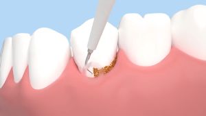 Electric Teeth Ultrasonic Set: Teeth Whitening & Tartar Removal