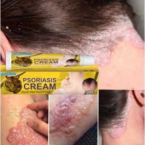 Psoriasis Eczema Cream 20g Skin Itching Itch Cream Antibacterial Ointment Skin Itch Relief Cream Skin Care Products Can Be Used All Over the Body Chinese Herbal Antibacterial