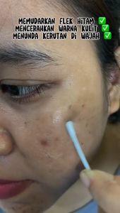 BPOM  CINDYNAL Skin Cream  Removal  /   Krim Perawatan Kulit Pemutih Efektif Pigmentasi Menghilangkan Melasma Jerawat Bintik Hitam Fuyan