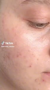 DRICHA ACNE SKIN ESSENCE Mitra Resmi Platinum Malang