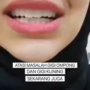 Gigi Palsu Pemutih & Veneer: Solusi Gigi Palsu Atas & Bawah