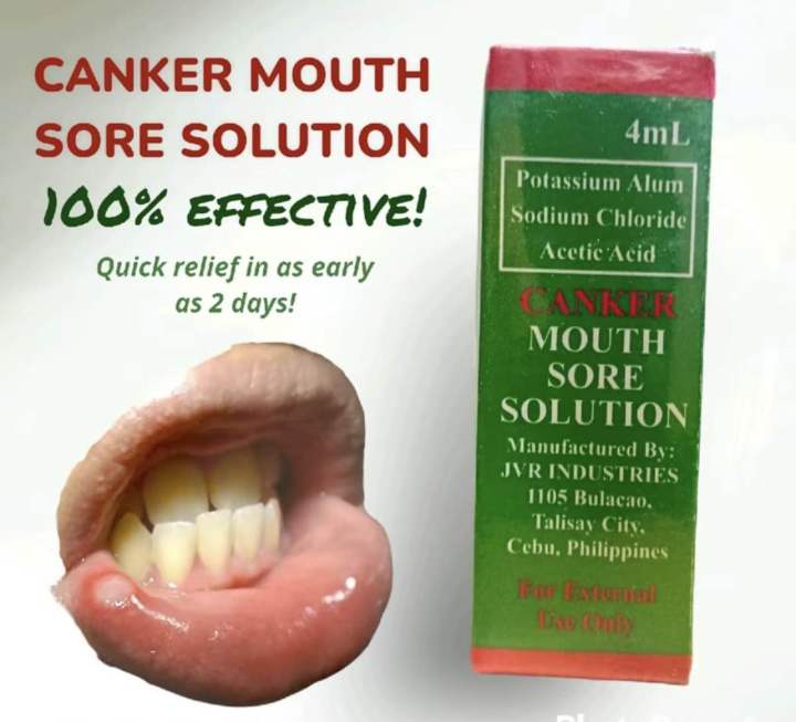 CANKER MOUTH SORE SOLUTION GAMUT SA SINGAW | Lazada PH