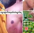မှဲ့ဖျက်ဆေး. 