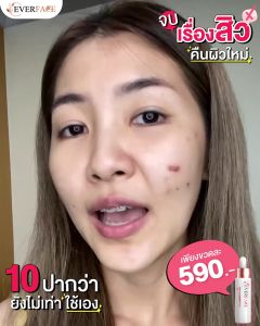 ประสิทธิภาพ: ตัวเดียวจบแก้ครอบ ทุกปัญหา หลุดสิว และ สิว