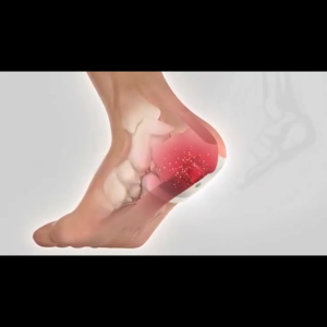 heel pain relief patchplantar fasciitis Special effect paste 12pcs Relief foot heel pain ankle pain Bone Spurs