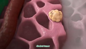 Obat Herbal Kanker Dan Tumor Ganas Obat Kanker Payudara Obat Kanker Serviks Herbal Galrida Bharata 100% Original