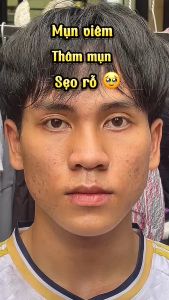 Serum Mụn Diếp Cá IGREEN Hỗ Trợ Giảm Mụn và Thâm Se Khít Lỗ Chân Lông Chăm Sóc Da Nam Nữ