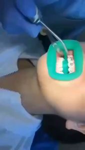 1pc Mouth Opener Dental Cheek Retractor Silicone Retracor Intraoral Lip and Cheek Retractor Oral Care Tool