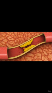 Obat Penghilang Plak Di Pembuluh Darah Tersumbat Kolesterol LDL Pembersih Darah Kotor Serangan Jantung Herbal Cardina Health Squalene Softgel