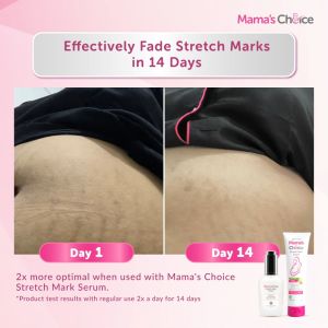 Mamas Choice Pregnancy Stretch Mark Treatment Set | Cream & Serum | Helps Fade Stretch Marks